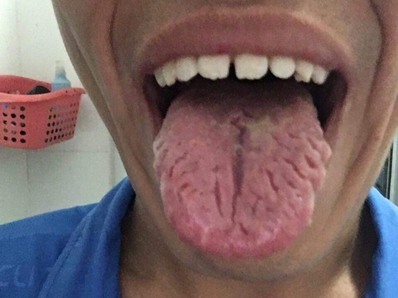 Nứt Lưỡi: Nguyên Nhân, Triệu Chứng Và Cách Điều Trị